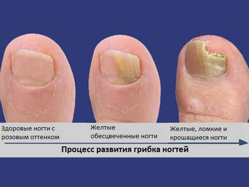 18 лучших средств от грибка ногтей — народный рейтинг