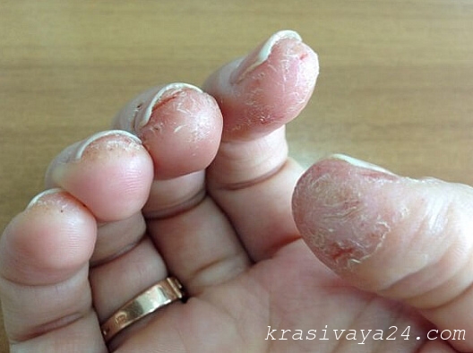 Аллергия на гель лак