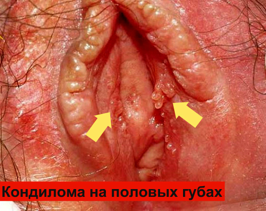Чем опасны шарики на половой губе, причины их появления