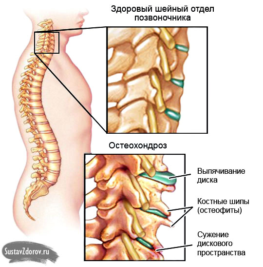Что такое остеохондроз – виды, симптомы и лечение