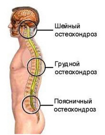 Что такое остеохондроз – виды, симптомы и лечение