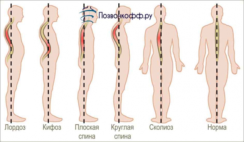 Что такое остеохондроз – виды, симптомы и лечение