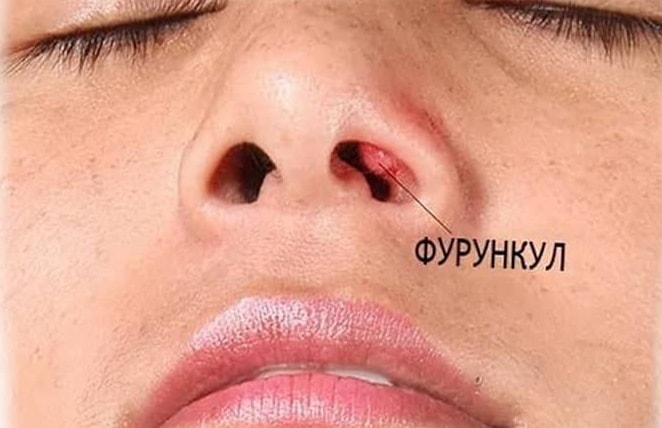 Фурункул в носу: причины, симптомы и способы лечения
