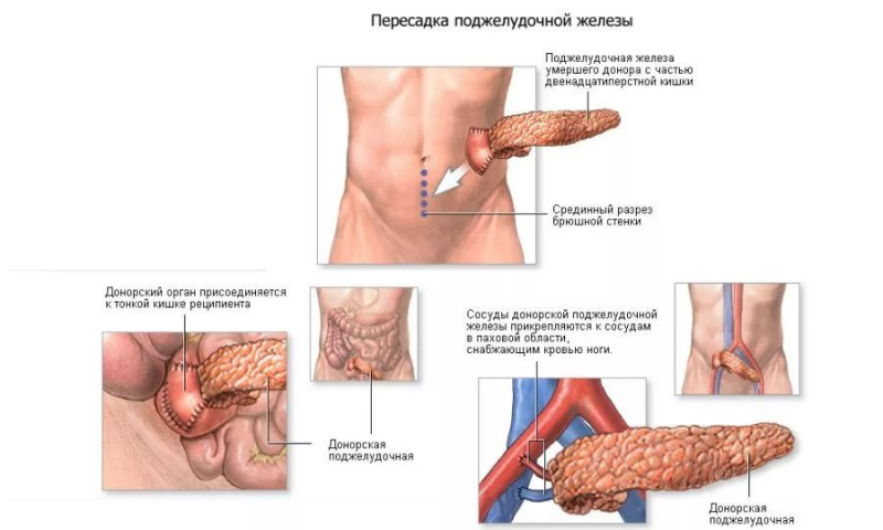 Гарвардскими специалистами создана искусственная поджелудочная железа
