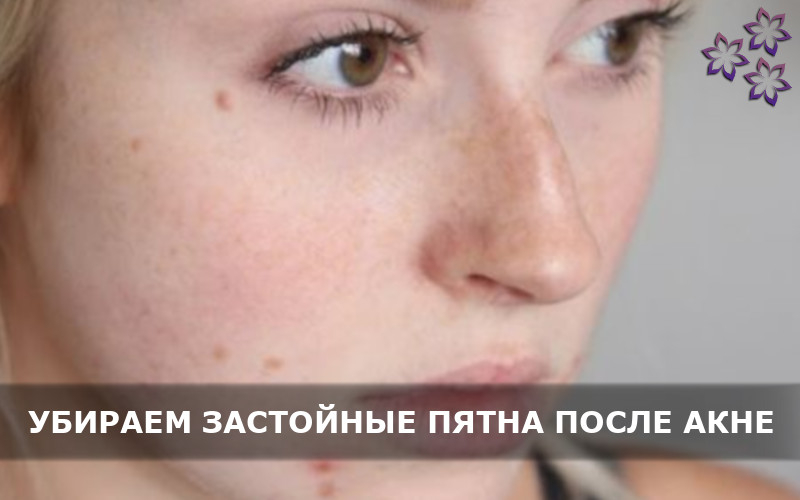 Как быстро убрать покраснения после выдавливания прыщика и почему нельзя их давить