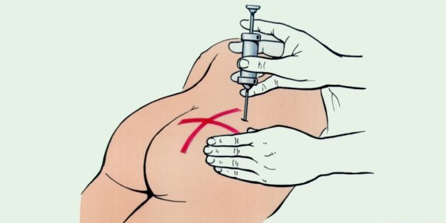 Как делать укол в ягодицу – самая подробная инструкция