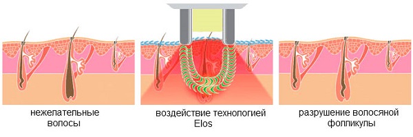 Как работает фотоэпилятор, и что это вообще такое