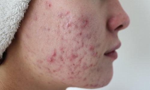 Как убрать болячки от прыщей с кожи лица и тела: средства народной медицины