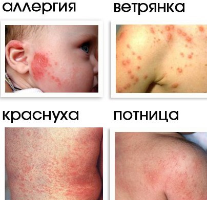 Лечение потнички у новорожденных: советы специалистов по уходу за кожей детей