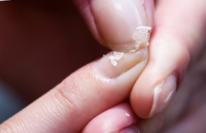 Ломкость ногтей – причины появления и методы лечения