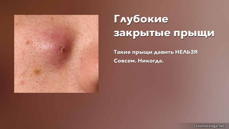 Можно ли давить прыщи – стадии развития и риски возможных осложнений