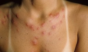 Муха, которая откладывает личинки под кожу человека