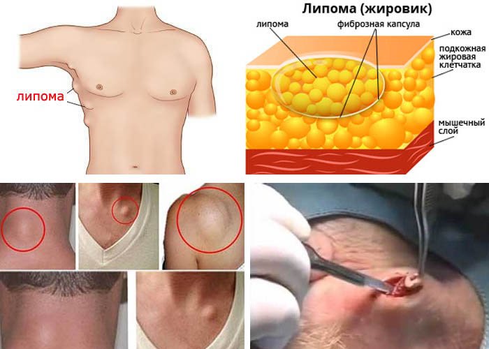 Народные средства от липомы: симптомы и лечение