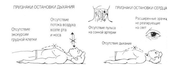 Первая помощь при остановке сердца: основные методы и техники