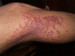 Песчаные блохи во вьетнаме
