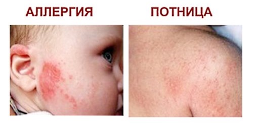 Потница или аллергия: в чем основные отличия патологий