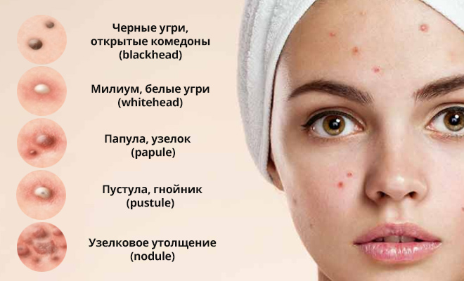 Прыщи на лице у мужчин: основные причины и способы лечения
