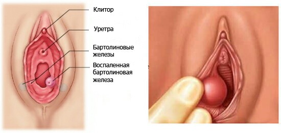 Шишка в промежности: возможные причины и методы лечения
