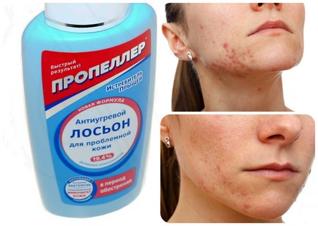Солярий против прыщей: реальная помощь или миф