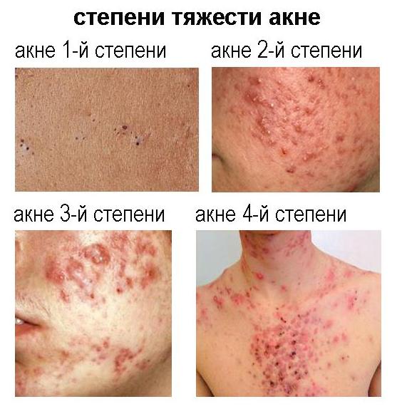 Спина в прыщах: типы, причины и способы лечения