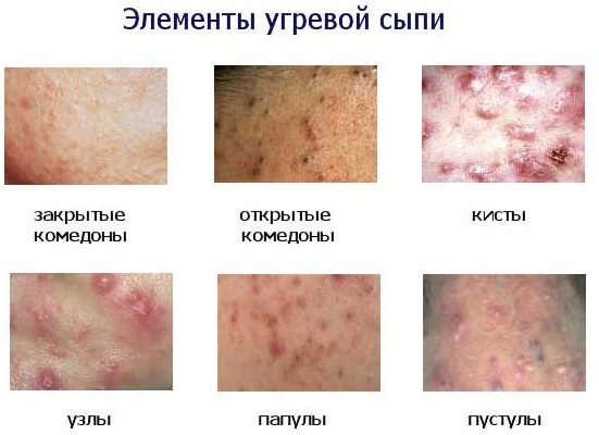 Спина в прыщах: типы, причины и способы лечения