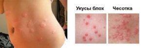 Температура от укусов комаров у взрослого и ребенка