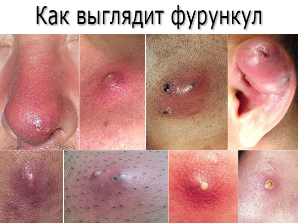 Внутренний фурункул: типы, факторы появления