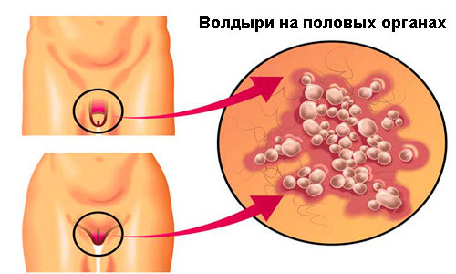 Волдыри на половом члене: причины появления, возможные последствия