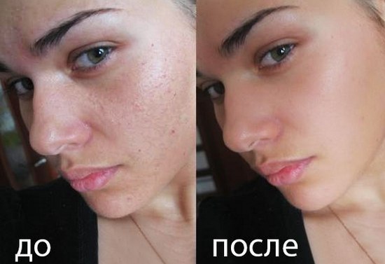 Желатиновые маски для лица в домашних условиях: популярные и эффективные рецепты