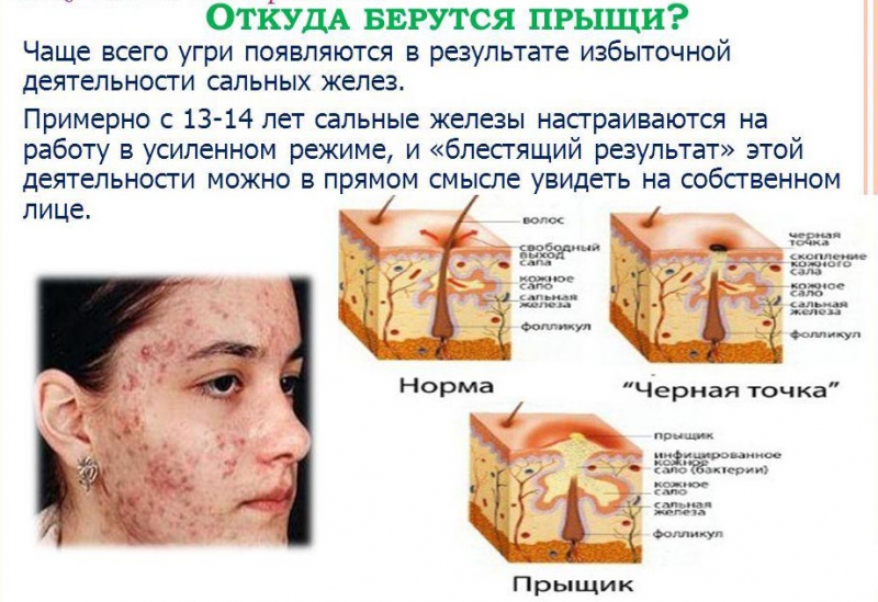 Зоны прыщей на лице: за какие органы отвечают воспаления на коже